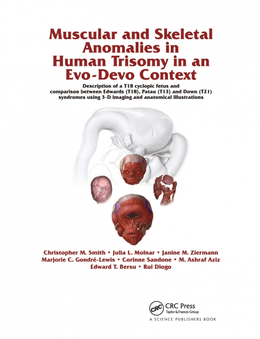 MUSCULAR AND SKELETAL ANOMALIES IN HUMAN TRISOMY IN AN EVO-D