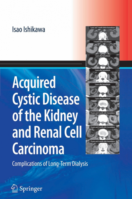 ACQUIRED CYSTIC DISEASE OF THE KIDNEY AND RENAL CELL CARCINO