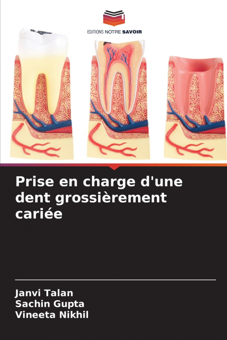 TRATAMENTO DE DENTES COM CARIES GROSSEIRAS