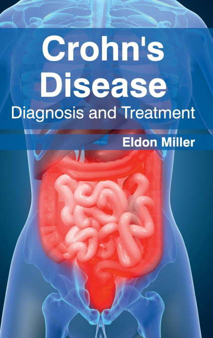 Crohn’s Disease