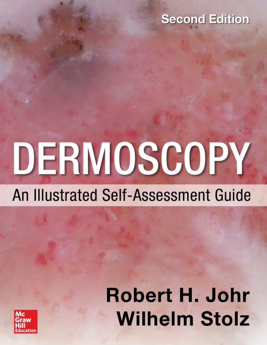 Dermoscopy