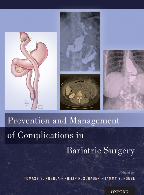 Prevention and Management of Complications in Bariatric Surgery