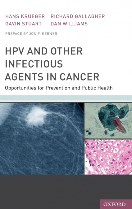 Hpv and Other Infectious Agents in Cancer