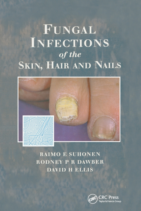 Fungal Infections of the Skin and Nails