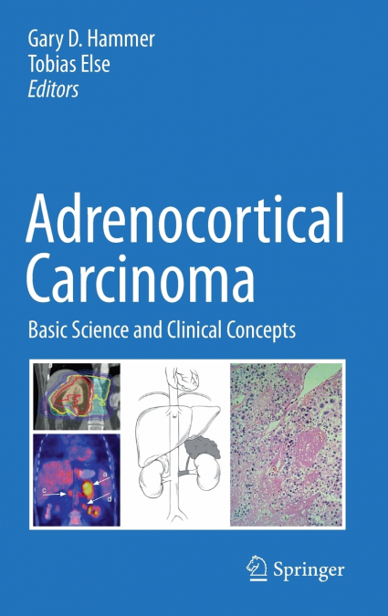 Adrenocortical Carcinoma