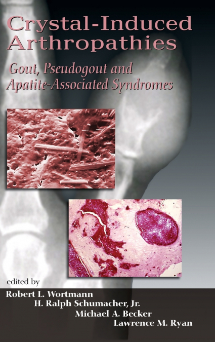 Crystal-Induced Arthropathies