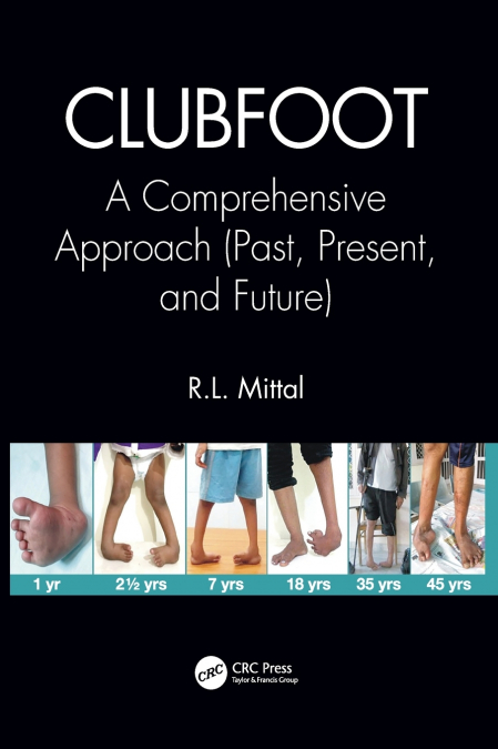 Clubfoot
