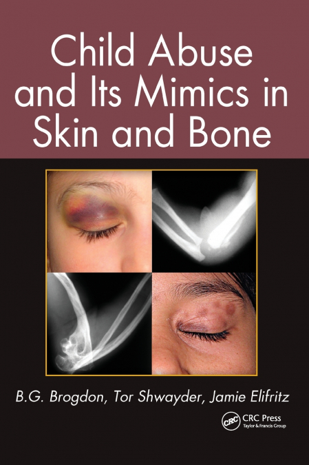Child Abuse and its Mimics in Skin and Bone