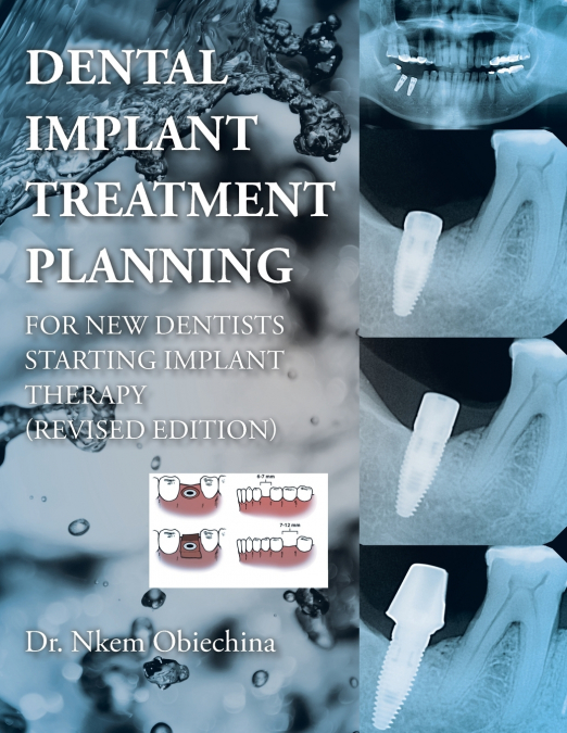 Dental Implant Treatment Planning for New Dentists Starting Implant Therapy