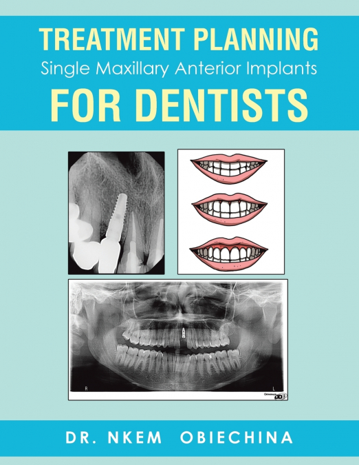 Treatment Planning Single Maxillary Anterior Implants for Dentists