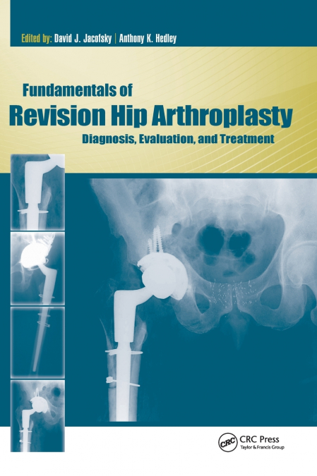 Fundamentals of Revision Hip Arthroplasty