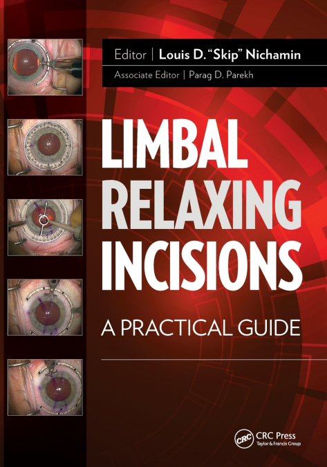 Limbal Relaxing Incisions