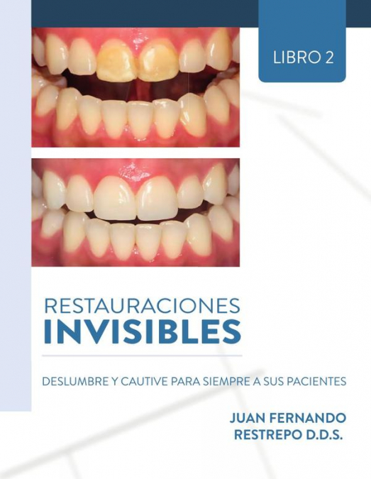 Restauraciones Invisibles: Deslumbre Y Cautive Para Siempre A Sus Pacientes