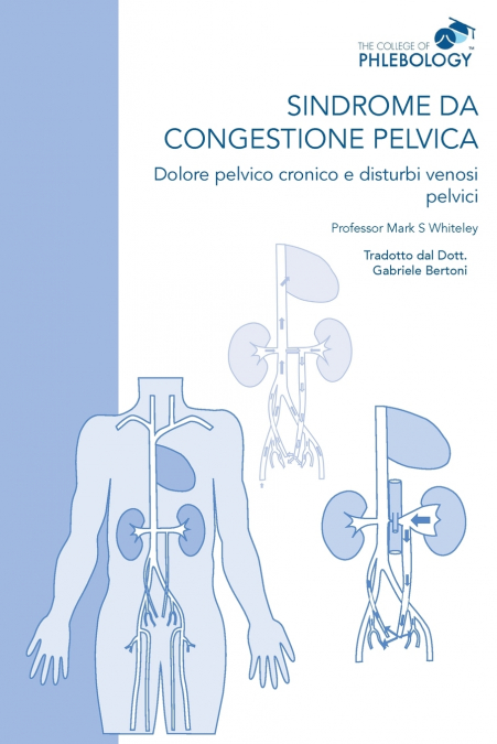 Sindrome da congestione pelvica - Dolore pelvico cronico e disturbi venosi pelvici