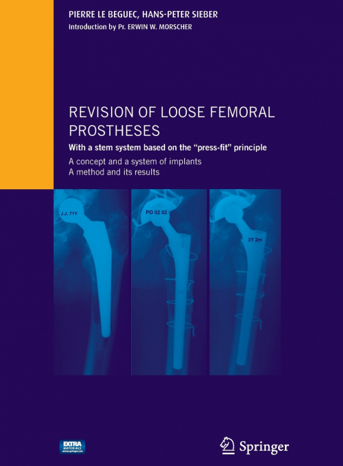 Revision of loose femoral prostheses with a stem system based on the 'press-fit' principle