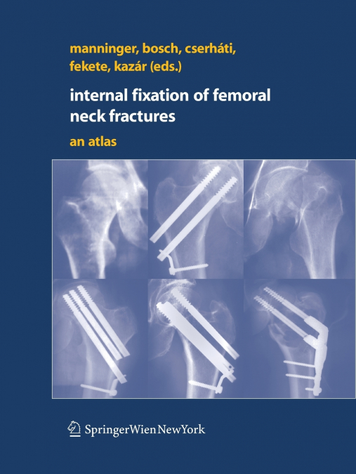 Internal fixation of femoral neck fractures