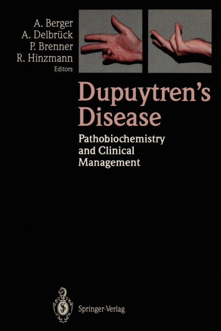 Dupuytren’s Disease