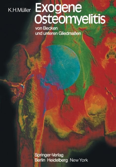 Exogene Osteomyelitis von Becken und unteren Gliedmaßen