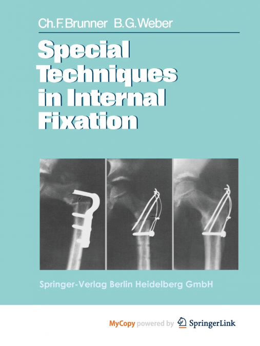 Special Techniques in Internal Fixation