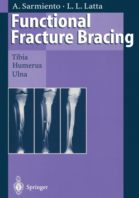 Functional Fracture Bracing