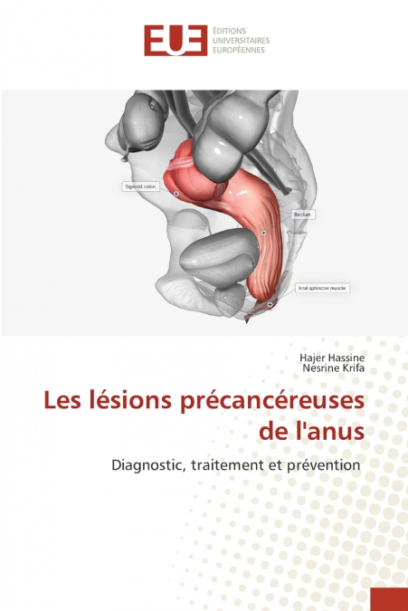 Les lésions précancéreuses de l’anus