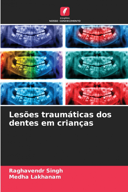 Lesões traumáticas dos dentes em crianças