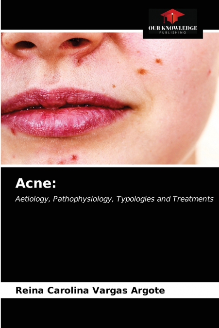 Acne