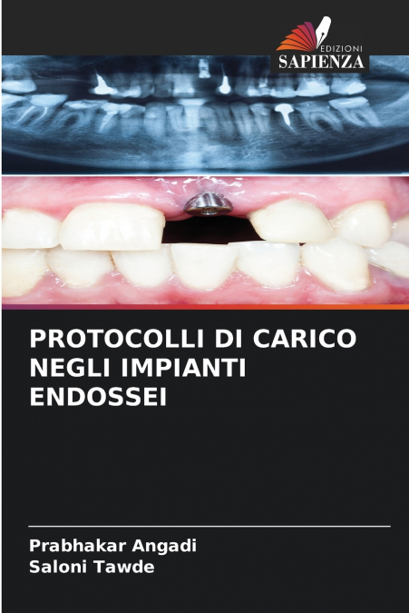 PROTOCOLLI DI CARICO NEGLI IMPIANTI ENDOSSEI