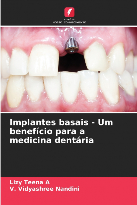 Implantes basais - Um benefício para a medicina dentária