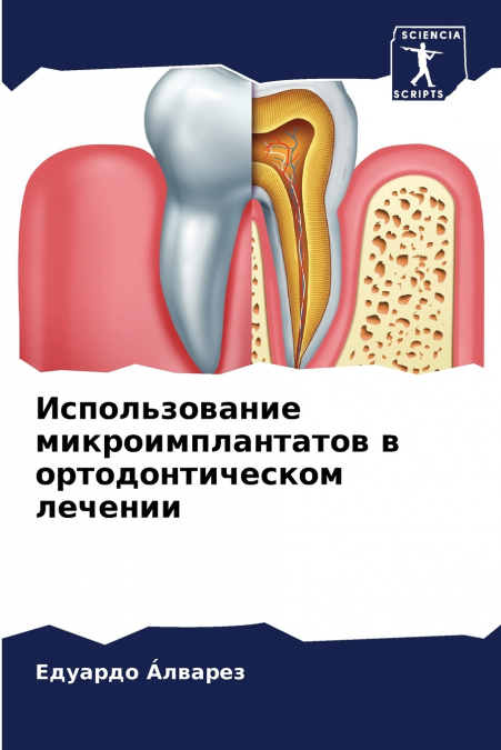 Использование микроимплантатов в ортодонтическом лечении