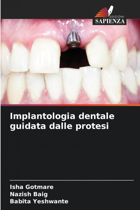 Implantologia dentale guidata dalle protesi