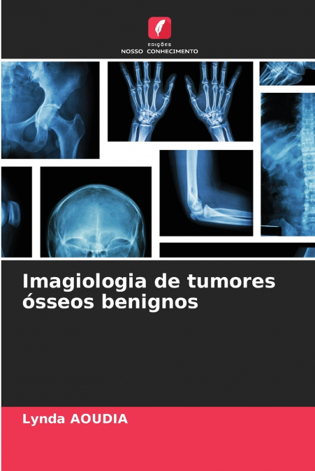 Imagiologia de tumores ósseos benignos