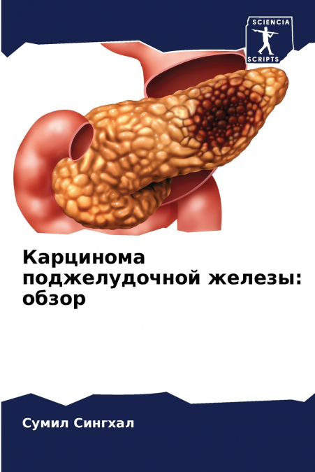 Карцинома поджелудочной железы