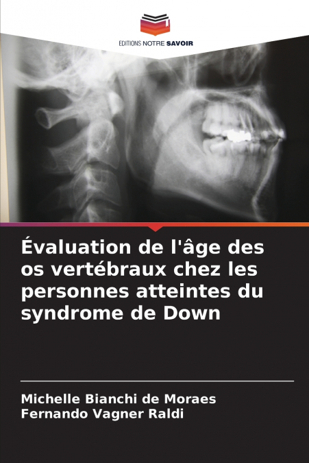 Évaluation de l’âge des os vertébraux chez les personnes atteintes du syndrome de Down