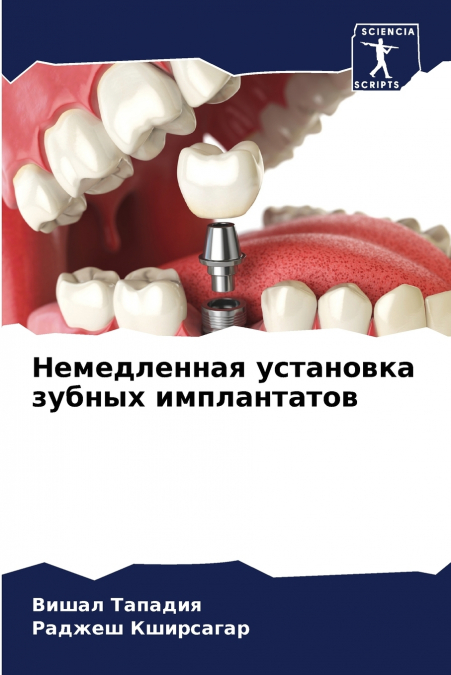 Немедленная установка зубных имплантатов
