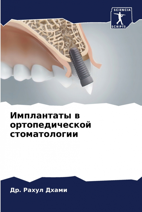 Имплантаты в ортопедической стоматологии