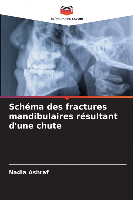Schéma des fractures mandibulaires résultant d’une chute