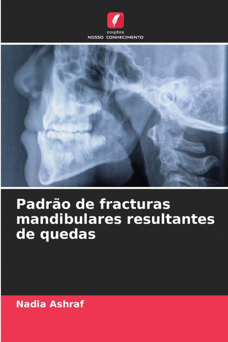 Padrão de fracturas mandibulares resultantes de quedas