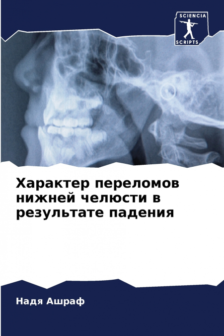 Характер переломов нижней челюсти в результате падения