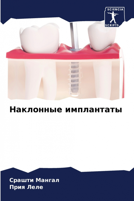 Наклонные имплантаты