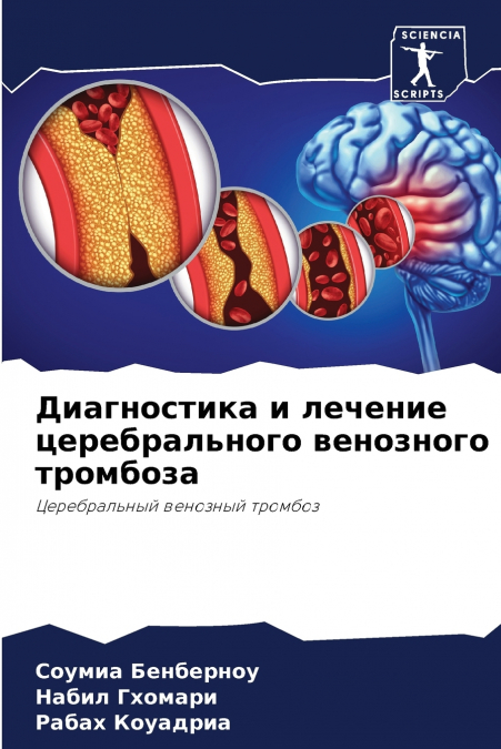 Диагностика и лечение церебрального венозного тромбоза