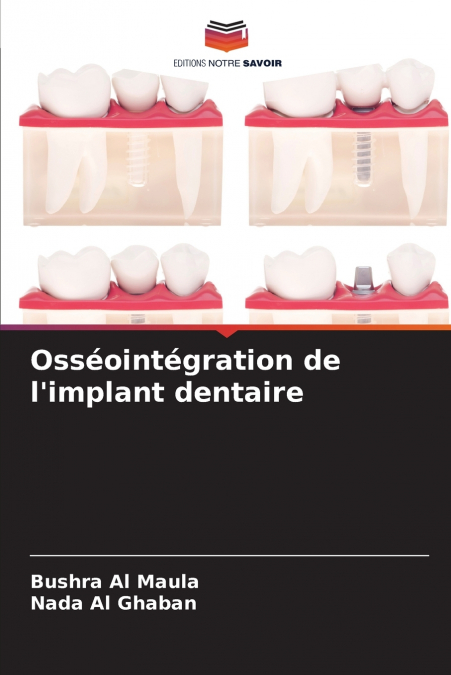 Osséointégration de l’implant dentaire