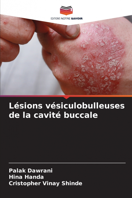 Lésions vésiculobulleuses de la cavité buccale