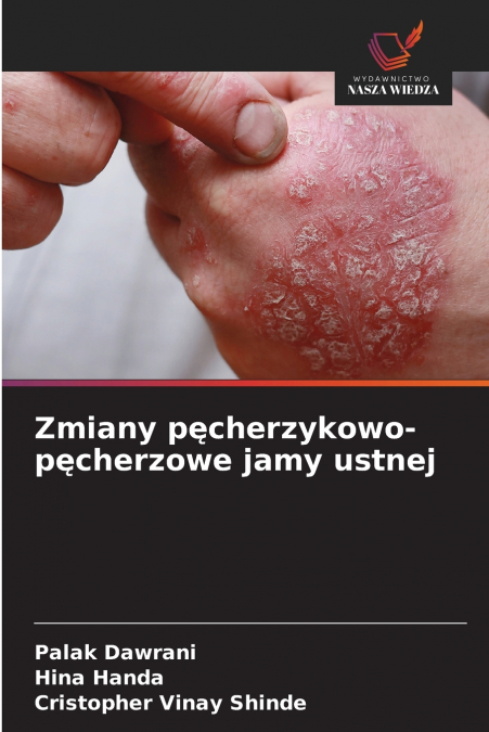 Zmiany pęcherzykowo-pęcherzowe jamy ustnej