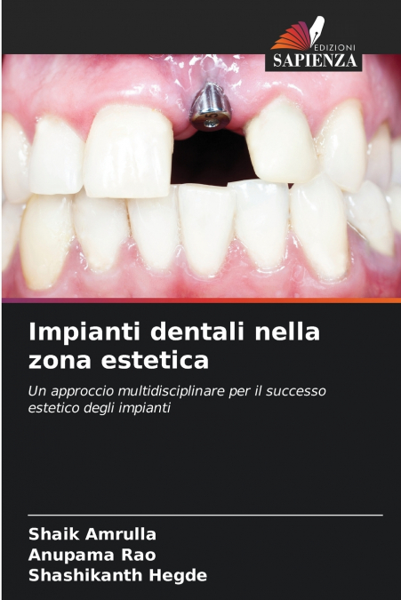 Impianti dentali nella zona estetica