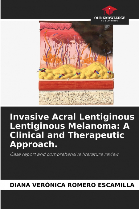 Invasive Acral Lentiginous Lentiginous Melanoma