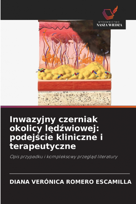 Inwazyjny czerniak okolicy lędźwiowej