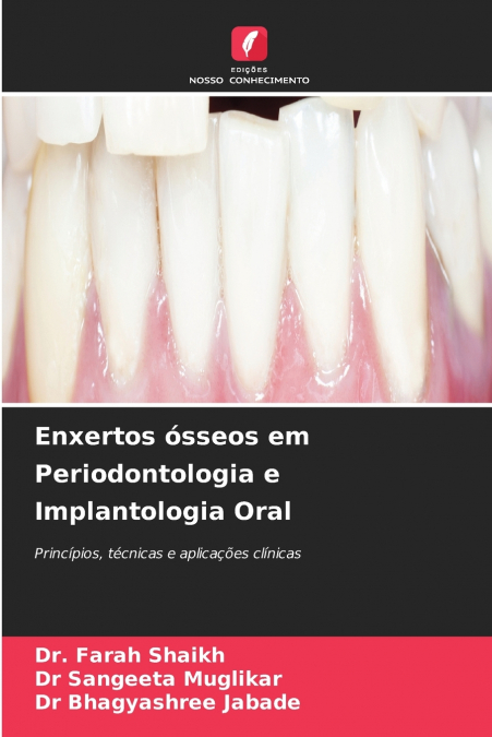 Enxertos ósseos em Periodontologia e Implantologia Oral