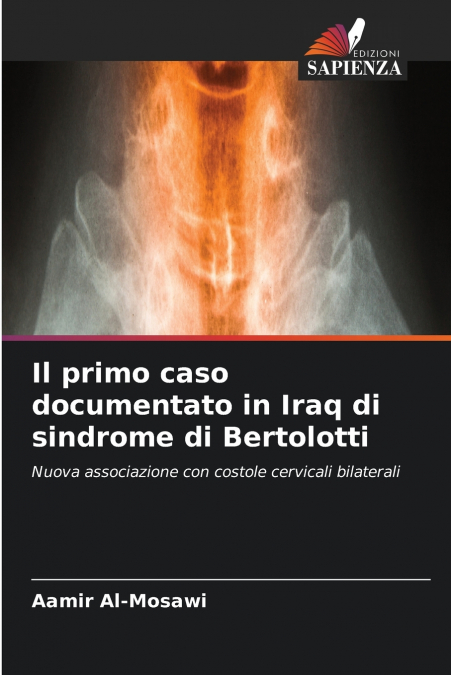Il primo caso documentato in Iraq di sindrome di Bertolotti