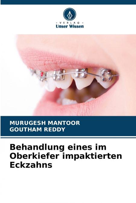 Behandlung eines im Oberkiefer impaktierten Eckzahns